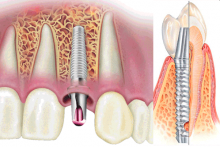 стоматология имплантация
