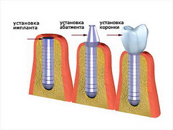 имплантация зубов в санкт петербурге